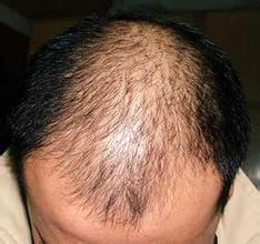 是什么原因造成男性同胞脱发而掉面子呢